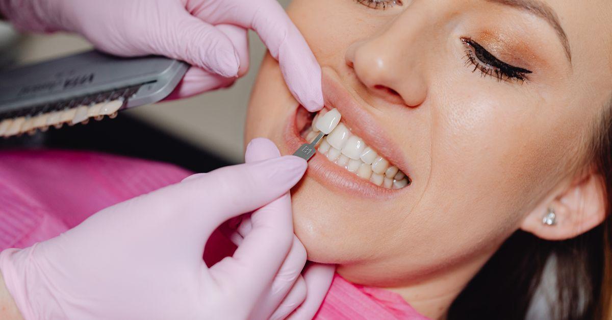 Benefícios das facetas de porcelana para sua imagem pessoal